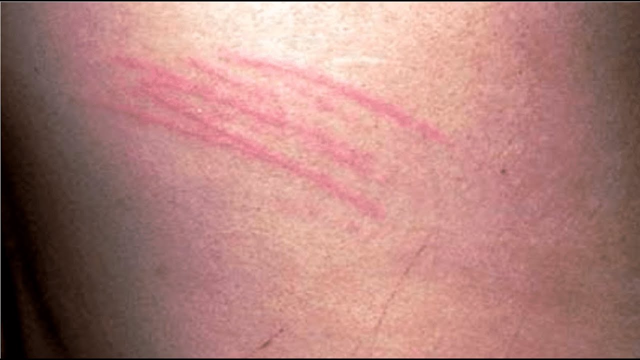 marcas en la piel como arañazos